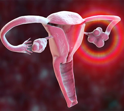 sindrome ovario poliquistico